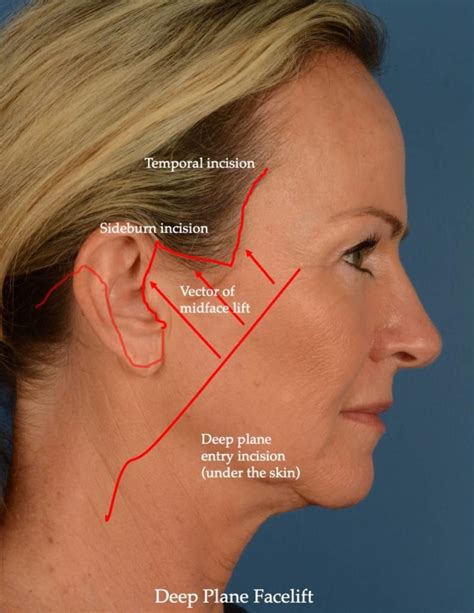 The Surgical Anatomy and the Deep Plane Thread Lift of the .